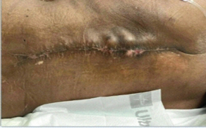 Figure 11: Clinical photographs of patient’s closed incision following months of wound debridement, antibiotic treatment, and complex closures by plastic surgery.