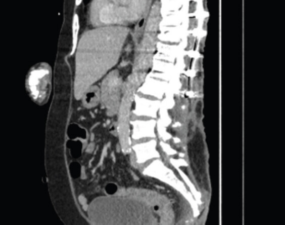 Figure 12: Sagittal cut of readmission thoracolumbar computed tomography scans. Continued sacral ulcer with erosion of sacrococcygeal junction likely due to osteomyelitis.