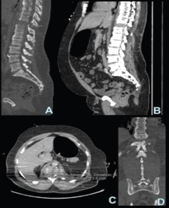 Figure 2: (a) (top left) and (b) (top right) are sagittal cuts of the initial thoracolumbar spine computed tomography (CT) scans. (c) (bottom left) is an axial cut of the initial thoracic spine CT scan at level T11-T12, and (d) (bottom right) is a coronal cut of the initial lumbar CT scan. Demonstrates fracture through a bridging T11-T12 syndesmophyte with 2 cm superior-inferior distraction and 8 mm retrolisthesis. There is also widening of facet joints indicating ligamentous injury.