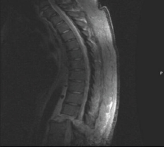 Figure 3: Sagittal cut of initial thoracolumbar magnetic resonance imaging (MRI) scan. Demonstrates fracture and distraction of the spinal column at T11-T12, with retrolisthesis which had progressed to 1.5 cm in the time between the initial computed tomography and initial MRI scan. There is also posterior stripping of the Dura and an associated collection of blood products.