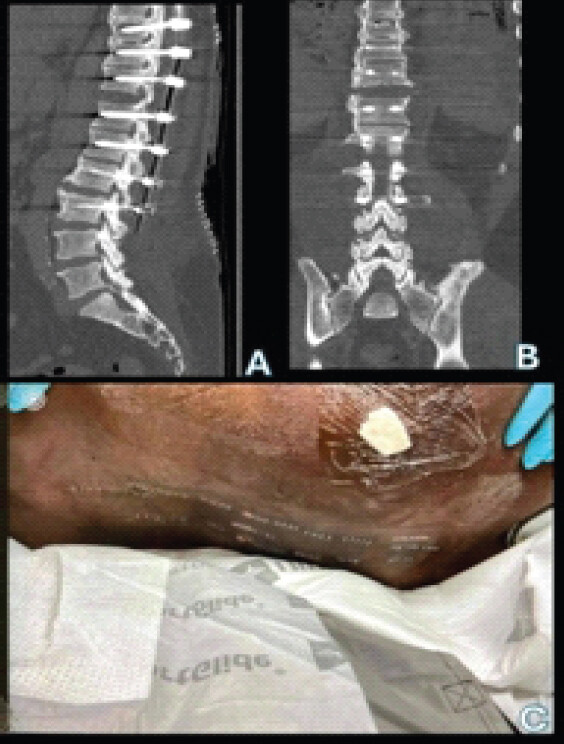 Figure 4: (a) (top left) is a sagittal cut and (b) (top right) is a coronal cut of the patient’s post-operative computed tomography scans. (c) (bottom) is a clinical photograph of the incision closure. S/p T9-L3 posterior fusion.