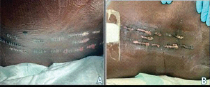 Figure 5: (a) (left) is a clinical photograph showing incisions on admission day 27. (b) (right) is a clinical photograph showing incisions on admission day 34.
