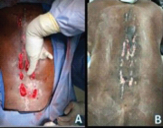 Figure 6: (a) (left) and (b) (right) are clinical photographs showing the intra-operative and post-operative incision and drainage wounds from admission day 47.