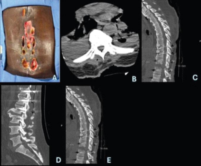 Figure 7: (a) (top left) is a clinical photograph showing wound breakdown from admission day 54. (b) (top middle) shows an axial cut of the pre-op thoracic computed tomography (CT) scan. (c) (top right), (d) (bottom left), and (e) (bottom middle) show sagittal cuts of the pre-op thoracolumbar CT scans. These demonstrate no failure of hardware but progressive wound breakdown, subcutaneous gas, and associated osteomyelitis.