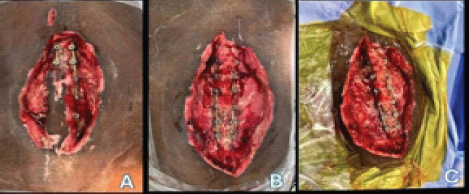 Figure 8: (a) (left) is a clinical photograph showing the wound pre-debridement on admission day 56. (b) (middle) and (c) (right) are clinical photographs showing pre- and post-debridement images of the wound on admission day 58.