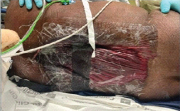 Figure 9: Patient pre-operative clinical photographs on admission day 63, which show wound vacuum-assisted closure and forming hematoma.