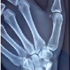 Proximal Hamate Autograft in Non-union Proximal Scaphoid Fractures, A Novel Technique – A Case Report