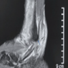 Split Peroneus Brevis: An Overlooked Cause of Ankle Dysfunction