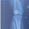 Arthroscopic Anterior Cruciate Ligament Reconstruction in a 17-Year-Old Female Athlete with Multiple Hereditary Exostoses Using a Peroneus Longus Autograft: A Rare Case Report