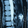 Osteochondroma of Dorsal Spine: A Rare Clinical Entity