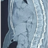 Deformity Correction in Ankylosing Spondylitis with Cervical Fracture: A Case Report