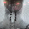 A Comparative Study of Piezoelectric Surgery versus High-Speed Drill in Cervical Spine Laminectomy