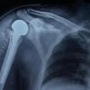 A Study on Functional Outcome of Hemiarthroplasty for Proximal Humeral Fractures – An Observational Study