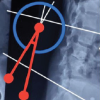 Posterior Decompression and Stabilization in Thoracic and Lumbar Spinal Tuberculosis: A Prospective Observational Study