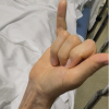 Zone III Small Finger Both Flexor Tendon Rupture after a Single Corticosteroid Injection: A Unique Case Report