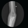 Isolated Coronoid Process Fracture in a 7-Year-Old Child – A Case Report