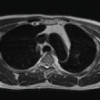 Delayed Spontaneous Pectoralis Major Tendon Rupture Following Anterior Latissimus Dorsi Transfer for Irreparable Subscapularis Tear: A Case Report