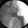 Total Hip Replacement after Acetabular Fracture Fixation: Surgical Challenges, Techniques, and Outcomes