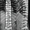 Multifocal Non-contiguous Spinal Tuberculosis: A Report of 3 Surgically-Treated Patients