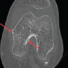 A Rare Case of Knee Orthogonal Injury in a Poliotic Limb, Managed Arthroscopically