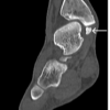 Symptomatic Accessory Ossicle Near the Medial Malleolus Simulating Fracture Non-union: A Case Report and Literature Review