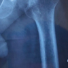 Managing Hip Arthritis in an Above-Knee Amputee: A Case Report of Total Hip Arthroplasty with Surgical Technique and Rehabilitation Considerations