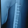 When the Nerve Lies Between the Fragments: A Mid-Shaft Humeral Fracture Mimicking a Holstein–Lewis Injury