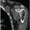 Symptomatic Fatty Involution of a Simple Bone Cyst in the Proximal Humerus: A Rare Case Report