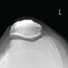 Single Peg Patellar Component Fracture in Total Knee Replacement: A Case Report
