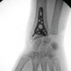 Case Report of Simultaneous Galeazzi Fracture Dislocation and Ipsilateral Scaphoid