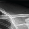Distal Clavicle Refracture after All-Suture Double Coracoclavicular and Acromioclavicular Stabilization: A Case Report