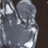 Tenosynovial Giant Cell Tumor of the Thumb with Bony Erosion – A Case Report on Surgical Excision with Adjuvant Chemical Cauterization