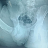 Traumatic Obturator Variant of Anterior Hip Dislocation – A Case Series