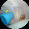 Painful Biceps Vincula: An Unrecognized Cause of Anterior Shoulder Pain