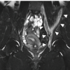Femoral Nerve Paralysis Associated with Traumatic Iliacus Hematoma: A Case Report