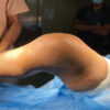 First Reported Case of Periprosthetic Fungal Knee Joint Infection Caused by Candida viswanathii: A Case Report
