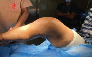Figure 1: Clinical image of right knee after primary implant dislocation showing swelling and local signs of inflammation.