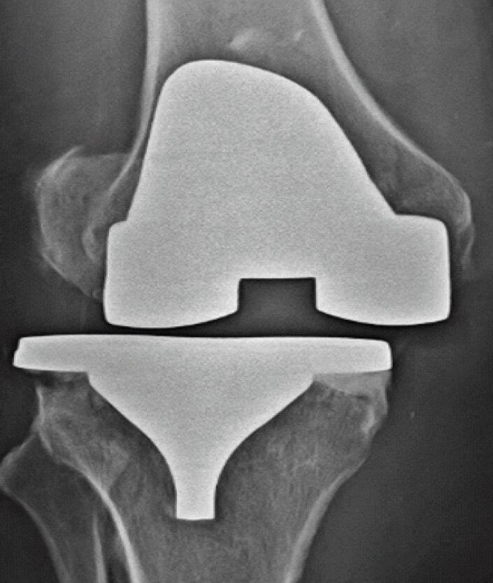 Figure 2: X-ray of the right knee in coronal (anteroposterior) view showing prosthesis instability with patellar dislocation.
