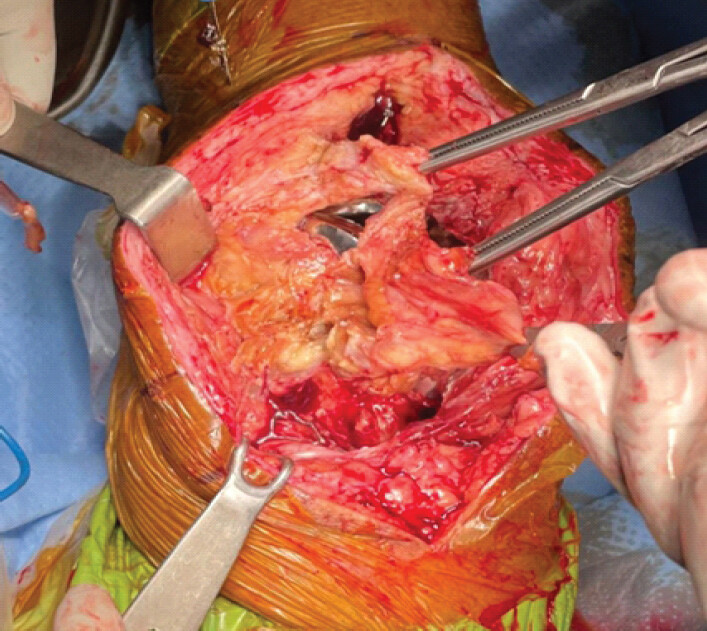 Figure 3: Intraoperative image during removal of primary implants and insertion of cement spacer showing extensive soft-tissue destruction, arthrotomy rupture, and patellar dislocation.