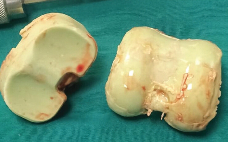 Figure 4: Intraoperative image showing the prepared dynamic cement spacer (femoral and tibial component).