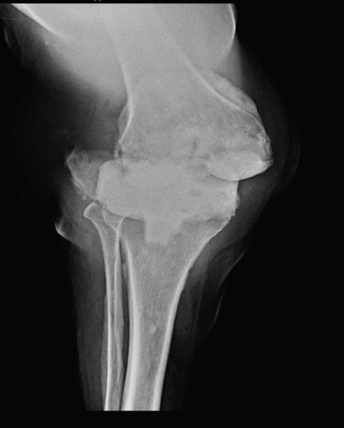 Figure 5: Radiological image: X-ray of the right knee in coronal (anteroposterior) view showing dislocation of the spacer with patellar dislocation.