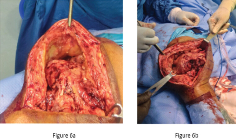 Figure 6: (a and b) Intraoperative images showing removal of the dynamic cement spacer and progressive soft tissue damage with arthrotomy rupture.