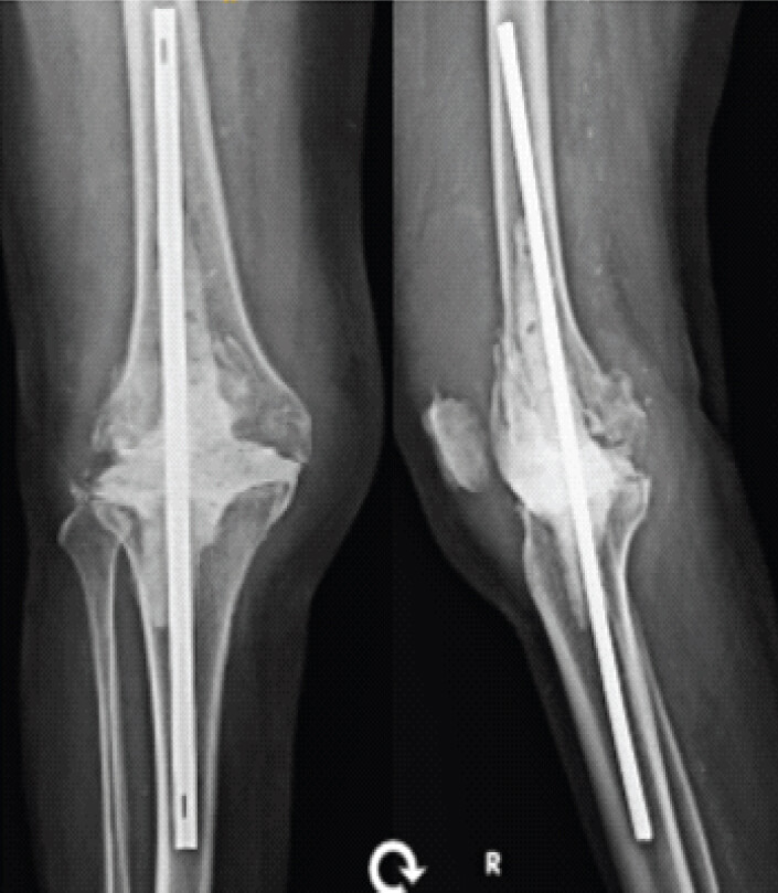 Figure 7: Radiological image: X-ray of the right knee in coronal (anteroposterior) and sagittal (lateral) views showing the insertion of the static spacer using an intramedullary polymethylmethacrylate-cemented K-nail construct.