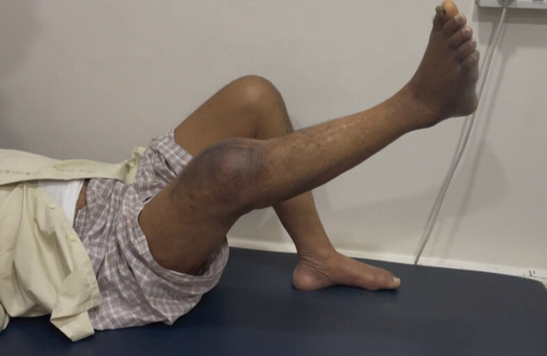 Figure 8: Clinical image showing the status of the patient at 1-year post-operative follow-up, showing the patient’s ability to perform a successful straight leg raise test.