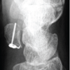 Hook Plate Fixation of an Isolated Pisiform Fracture with a Small Proximal Fragment: A Case Report