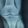 Semitendinosus Autograft Reconstruction for Neglected Patellar Tendon Rupture: Technical Simplicity with Excellent Outcome