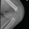 Idiopathic Congenital Dislocation of the Knee: Case Series of Spontaneous Reduction