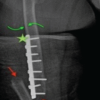 Peri-implant Femoral Fracture: An Uncommon Presentation in a Patient with Hallermann–Streiff Syndrome – A Case Report and Review of the Literature