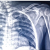 Bilateral Shoulder Dislocation with Fracture of Major Tubercles – A Case Report
