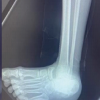 Isolated Medial Peritalar Dislocation Following High-Energy Trauma: A Case Report